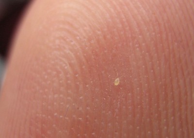 milbe auf finger.jpg